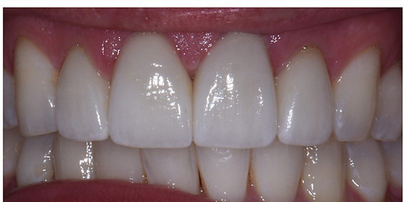 After anterior restoration at Carat Smiles, Greater Kailash