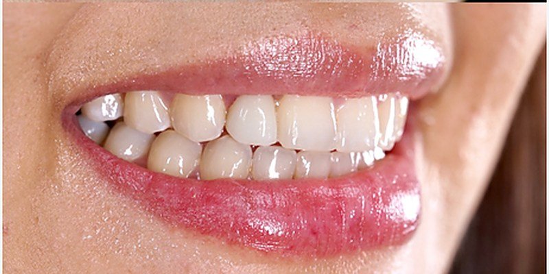 After implant crown at Carat Smiles, Greater Kailash