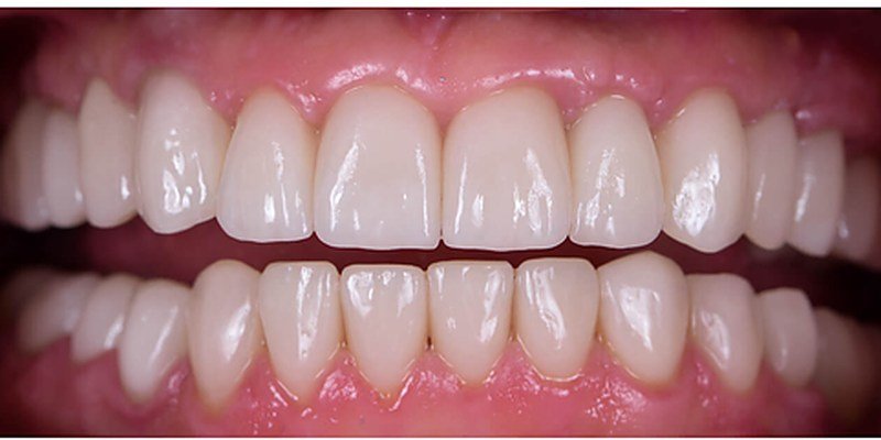 After full mouth rehab at Carat Smiles, Greater Kailash