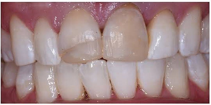 Before anterior restoration at Carat Smiles, Greater Kailash