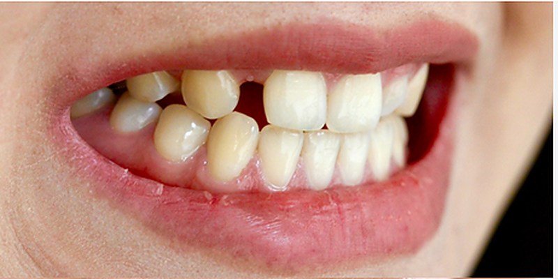 Before implant crown at Carat Smiles, Greater Kailash