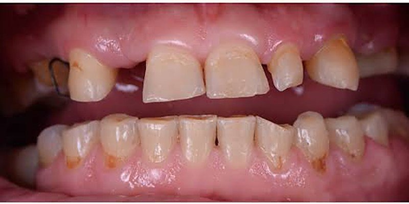 Before full mouth rehab at Carat Smiles, Greater Kailash