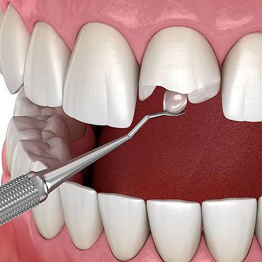 Broken or chipped tooth treated at Carat Smiles, Greater Kailash