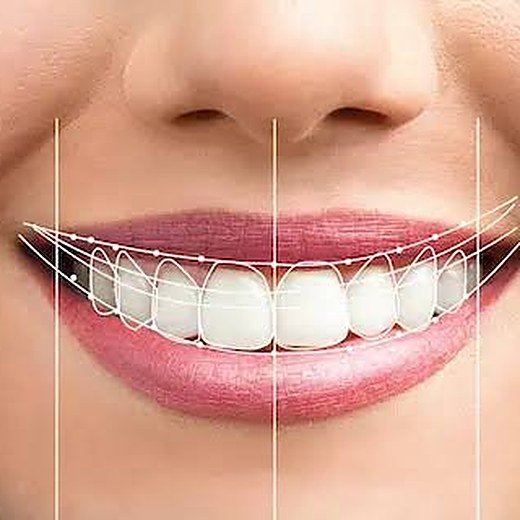 Crooked front teeth treated at Carat Smiles, Greater Kailash