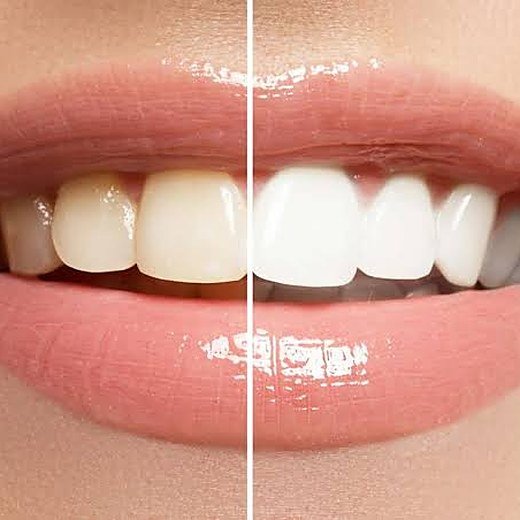 Discoloured teeth treated at Carat Smiles, Greater Kailash