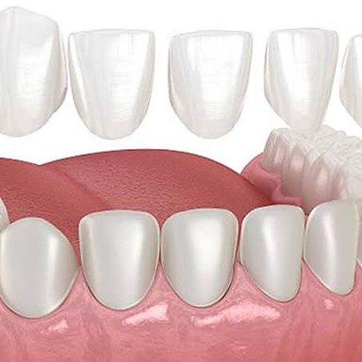 Gaps between front teeth treated at Carat Smiles, Greater Kailash