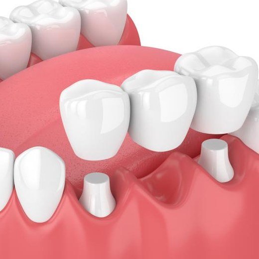A crown that keeps coming off treated at Carat Smiles, Greater Kailash