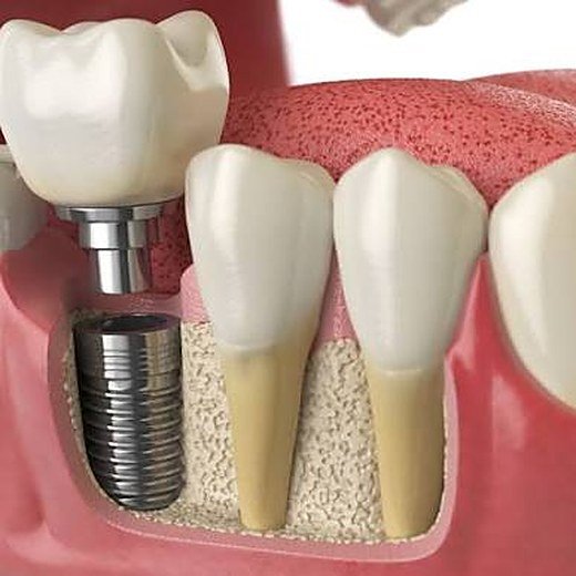 Missing teeth treated at Carat Smiles, Greater Kailash
