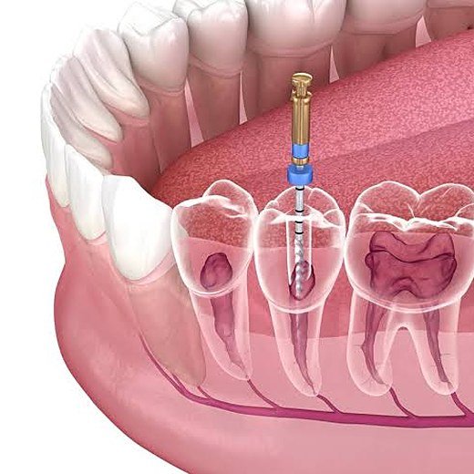 Toothache at night treated at Carat Smiles, Greater Kailash