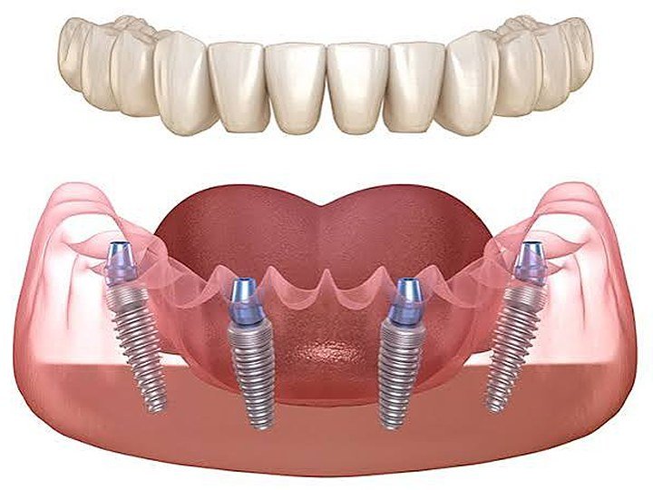 All-on-4 Implants at Carat Smiles, Greater Kailash 1, New Delhi