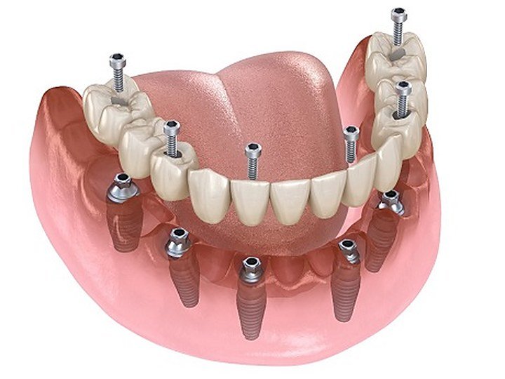 All-on-6 Implants at Carat Smiles, Greater Kailash 1, New Delhi