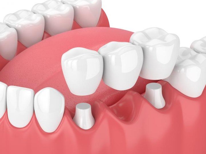 Crowns & Bridges at Carat Smiles, Greater Kailash 1, New Delhi