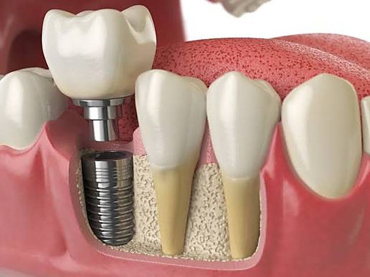 Dental Implants at Carat Smiles, Greater Kailash 1, New Delhi