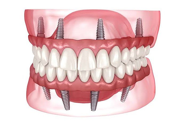 Full Mouth Implants at Carat Smiles, Greater Kailash 1, New Delhi