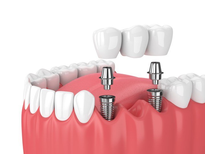 Implant-Supported Teeth at Carat Smiles, Greater Kailash 1, New Delhi