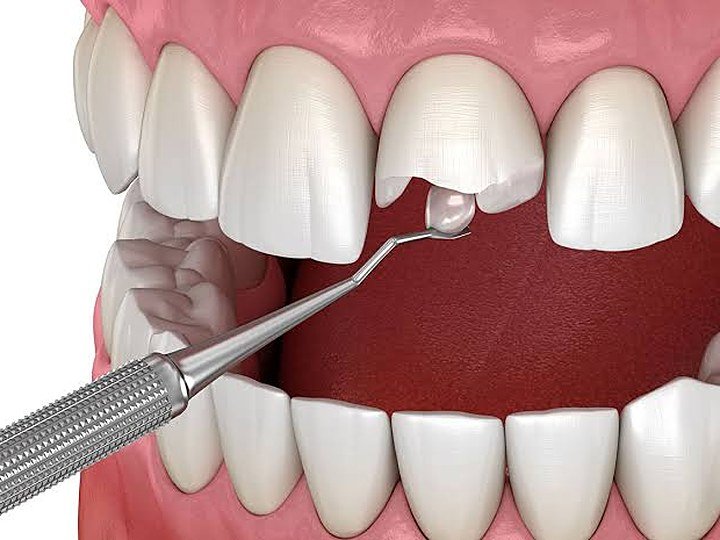 Restorative Dentistry at Carat Smiles, Greater Kailash 1, New Delhi