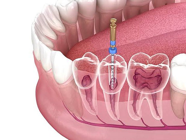 Root Canal Treatment at Carat Smiles, Greater Kailash 1, New Delhi