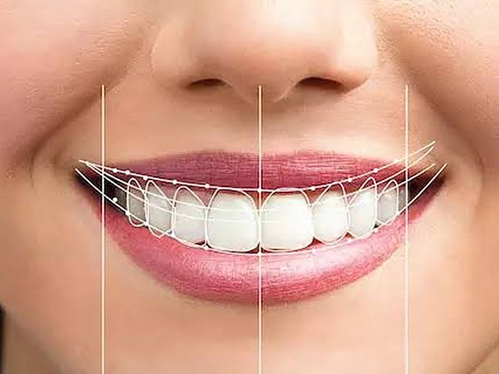 Smile Makeover at Carat Smiles, Greater Kailash 1, New Delhi
