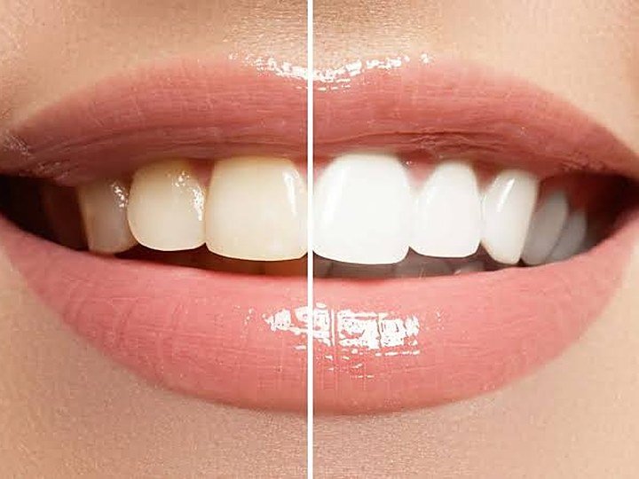 Teeth Whitening at Carat Smiles, Greater Kailash 1, New Delhi