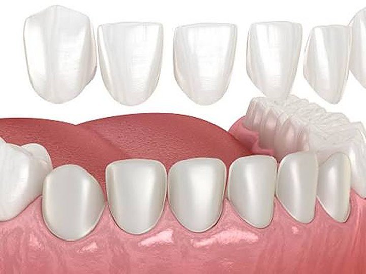 Porcelain Veneers at Carat Smiles, Greater Kailash 1, New Delhi